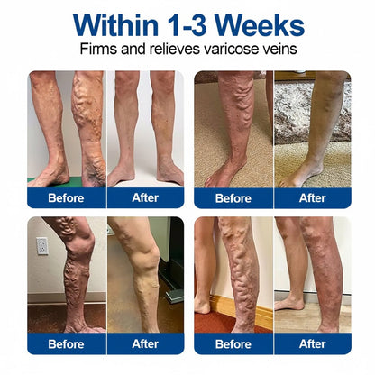 🥰🥰IE👨‍⚕️✅ Natravor® VeinEase Microneedle Care Patch ⚡ Fast Comfort, Lasting Leg Support