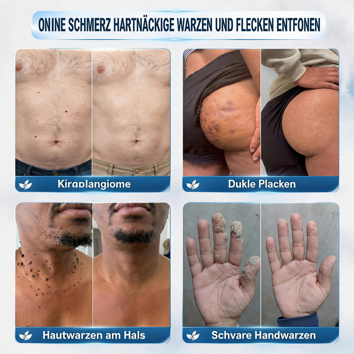 🇩🇪 Natravor® 🥑𝟕-𝐓𝐚𝐠𝐞 𝐇𝐚𝐮𝐭𝐚𝐧𝐡ä𝐧𝐠𝐬𝐞𝐥- & 𝐅𝐥𝐞𝐜𝐤𝐞𝐧-𝐄𝐧𝐭𝐟𝐞𝐫𝐧𝐮𝐧𝐠𝐬𝐜𝐫𝐞𝐦𝐞 (𝐒𝐜𝐡𝐦𝐞𝐫𝐳𝐟𝐫𝐞𝐢𝐞 𝐅𝐨𝐫𝐦𝐞𝐥 – 𝐨𝐡𝐧𝐞 𝐍𝐚𝐫𝐛𝐞𝐧)e